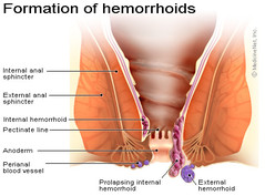hemorrhoid-cure-diagram.jpg