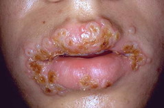 Nanda Herpes Simplex - Nursing Diagnosis.jpg