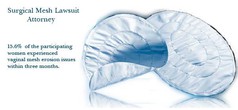 Transvaginal-Mesh-Lawsuit.jpeg