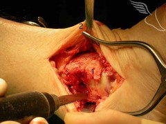 open-ankle-fusion-15.jpg