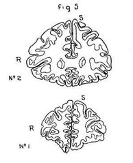 negro corpus callosum vs aryan corpus callosum.jpg negro corpus callosum vs aryan corpus callosum.jpg