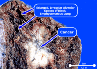 lung_cancer.gif