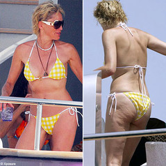 cellulite-stone.jpg