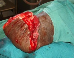 amputation-21.jpg