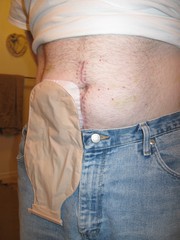 colostomy bag.JPG