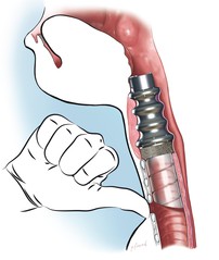 larynx artificial.jpg