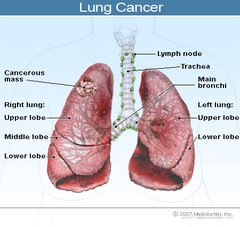 lung-cancer.jpg