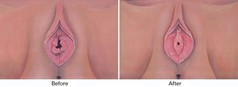hymen repair.jpg