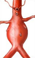 aorta.jpg