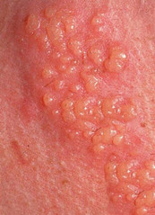herpes-bumps-on-skin.jpg