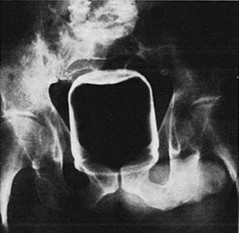 peanut_butter_jar_xray_ouch.jpg