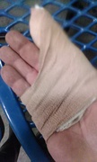 Berts injured hand.jpg