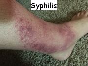 Matts Infected leg Syphilis.jpg